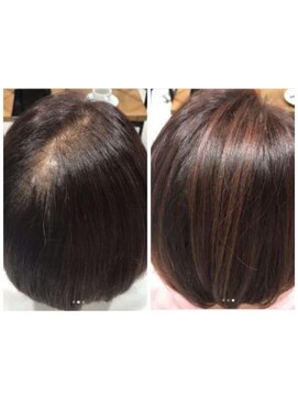 ライムヘアービューティフィー(Lime hair beautify) ヒト幹細胞使用【強髪】育毛促進　30代、40代、50代