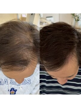 シール(Syl) プロセルセラピーズ 症例