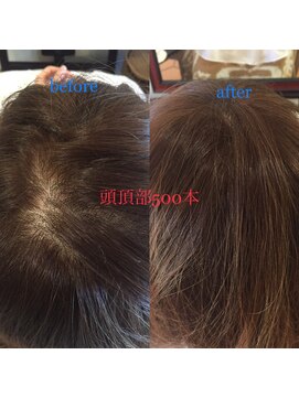 カラーワールド カンナヘアーメゾン(color world canna hair maison) 増毛エクステ 頭頂部500本 ふんわりナチュラルブラウン