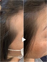 レヴィア(revia)&nbsp;プレミアム育毛促進美髪コース8ヶ月後の効果