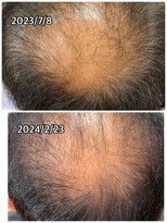 エミ(EMI)&nbsp;育毛促進