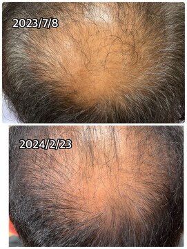 エミ(EMI) 育毛促進