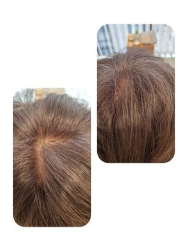 ユーフォルムギンザ(y-Forme Ginza) 話題のトキカタ♪頭頂部編