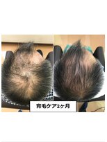 フォレスト(forest) 育毛促進ケア