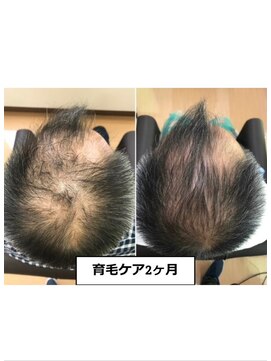 フォレスト(forest) 育毛促進ケア