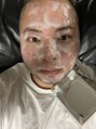 グレネイドスマートサロン(Grenade Smart Salon) 炭酸パックは、エニシーグローパックを愛用中