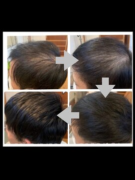 ルバートギンザ(rubato ginza) ヒト幹細胞/毛根改善/頭皮改善