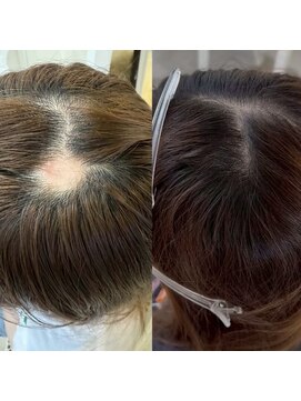 シール(Syl) プロセルセラピーズ 症例