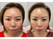 エリア初♪エクソソーム「加齢で減る“情報伝達物質”を補い、 肌の内側から再構築する新時代の美容体験。