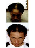 【抜け毛 予防 改善】育毛促進ケア