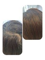 ユーフォルムギンザ(y-Forme Ginza)&nbsp;話題のトキカタ♪頭頂部編