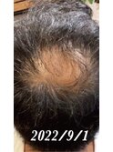 再髪コース（4ヶ月経過）