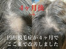 頭皮改善の事例です