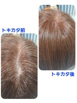 ユーフォルムギンザ(y-Forme Ginza)&nbsp;話題のトキカタ♪頭頂部編