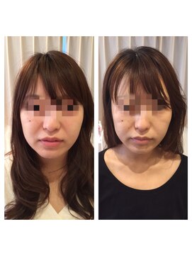 アドール(ADOR) 韓国式小顔コルギ