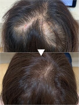 レヴィア(revia) 育毛促進美髪コース4ヶ月後の効果[水戸/髪質改善]