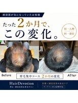ヘアディボーション(HairDevotion)&nbsp;育毛集中コース2か月経過実例