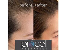 気になる顔まわりの産毛もしっかり育ちます。