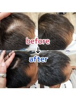 ブルーフィン シセロ(Blue Fin cicero) 頭皮改善!育毛促進ケア!