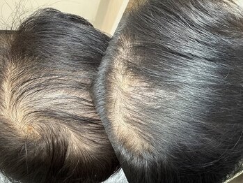 ビリーズ ヘアー(BIRI'S HAIR)の写真/ナノサイズまで加圧する水光(高圧)ジェット/エレクトロポレーションを使用した本格育毛促進ヘッドスパ！