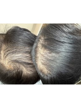 ナノサイズまで加圧する水光(高圧)ジェット/エレクトロポレーションを使用した本格育毛促進ヘッドスパ！