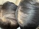 ビリーズ ヘアー(BIRI'S HAIR)の写真/ナノサイズまで加圧する水光(高圧)ジェット/エレクトロポレーションを使用した本格育毛促進ヘッドスパ！