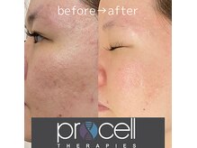 毛穴・赤味など肌質改善にも大人気！