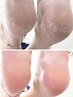 フット角質ケア/サンダルを履く前に!