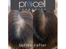 頭頂部のボリュームが気になる方のお悩みにも。