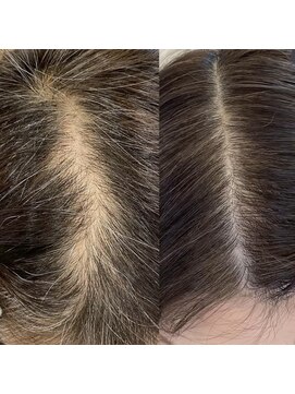 シール(Syl) プロセルセラピーズ 症例