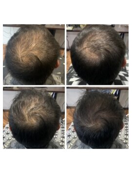 ゴールデンエイジ(Golden Age) 【　　　発　　毛　　ケ　　ア　　12ヶ月推移　　　　】