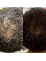 シール(Syl)&nbsp;プロセルセラピーズ 症例