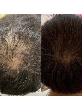 シール(Syl) プロセルセラピーズ 症例