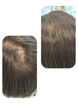 ユーフォルムギンザ(y-Forme Ginza)&nbsp;話題のトキカタ♪頭頂部編