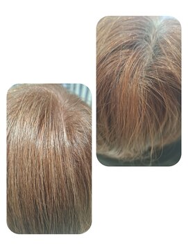 ユーフォルムギンザ(y-Forme Ginza) 話題のトキカタ♪頭頂部編