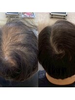 シール(Syl)&nbsp;プロセルセラピーズ 症例