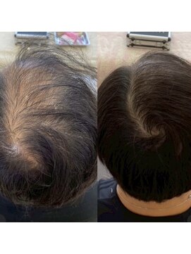 シール(Syl) プロセルセラピーズ 症例