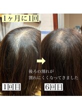 個室で受けられる育毛促進メニュー【強髪】ヒト幹細胞培養液を使用した最新のエイジングケアです