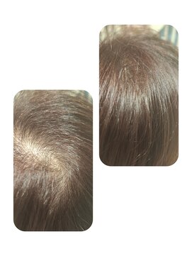 ユーフォルムギンザ(y-Forme Ginza) 話題のトキカタ♪頭頂部編