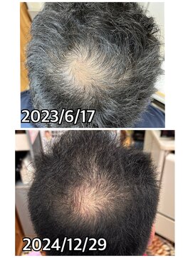 エミ(EMI) 育毛促進