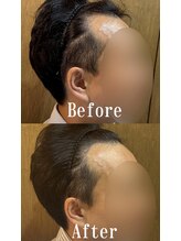 アフロ(AFRO)&nbsp;へアルプ 