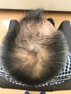 フォレスト(forest) 育毛促進 【詐術前】