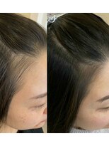 髪質改善 ソアリス 烏丸丸太町店(soiris)&nbsp;頭皮改善エステ(細毛トリートメント)