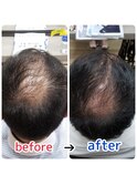頭皮改善！育毛促進ケア！