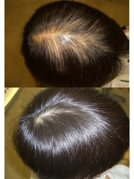 リフュージュ(refuge) 【抜け毛 予防 改善】育毛促進