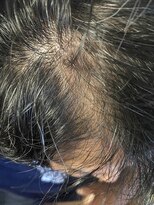 グローリープラス(glory+)&nbsp;育毛促進日記