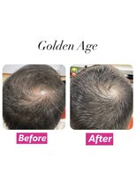 ゴールデンエイジ(Golden Age)&nbsp;【　発　毛　ケ　ア ２ヶ月】