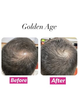 ゴールデンエイジ(Golden Age) 【　発　毛　ケ　ア ２ヶ月】