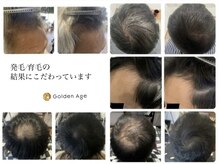 ゴールデンエイジ(Golden Age)の雰囲気（実際の症例「頭皮・髪の状態を見極め施術します」）
