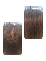 ユーフォルムギンザ(y-Forme Ginza)&nbsp;話題のトキカタ♪頭頂部編